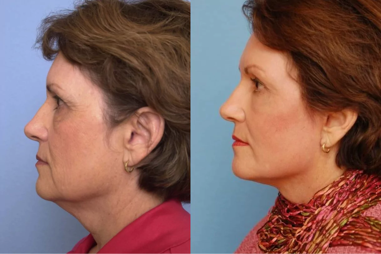 facelift before after