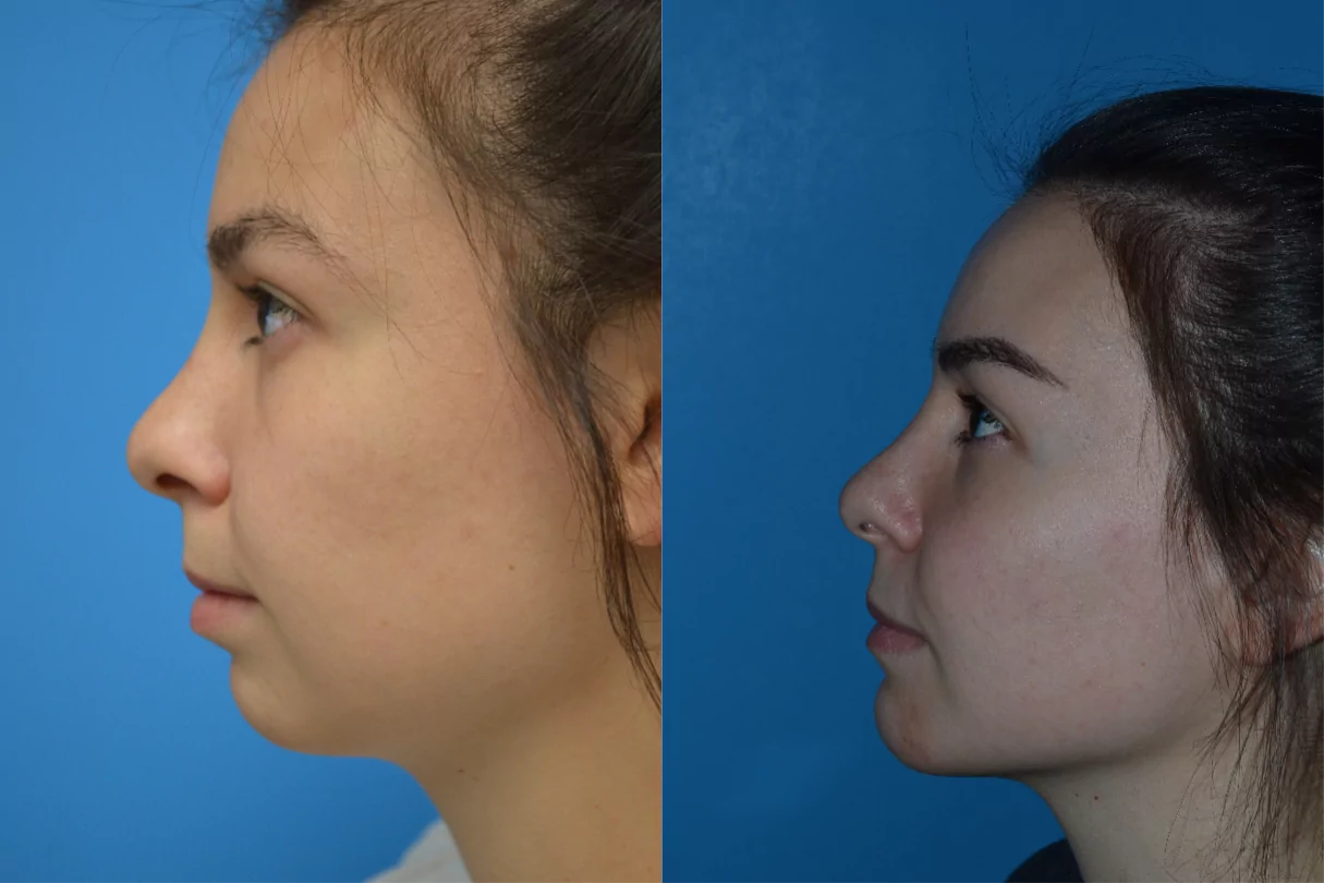 genioplasty before after