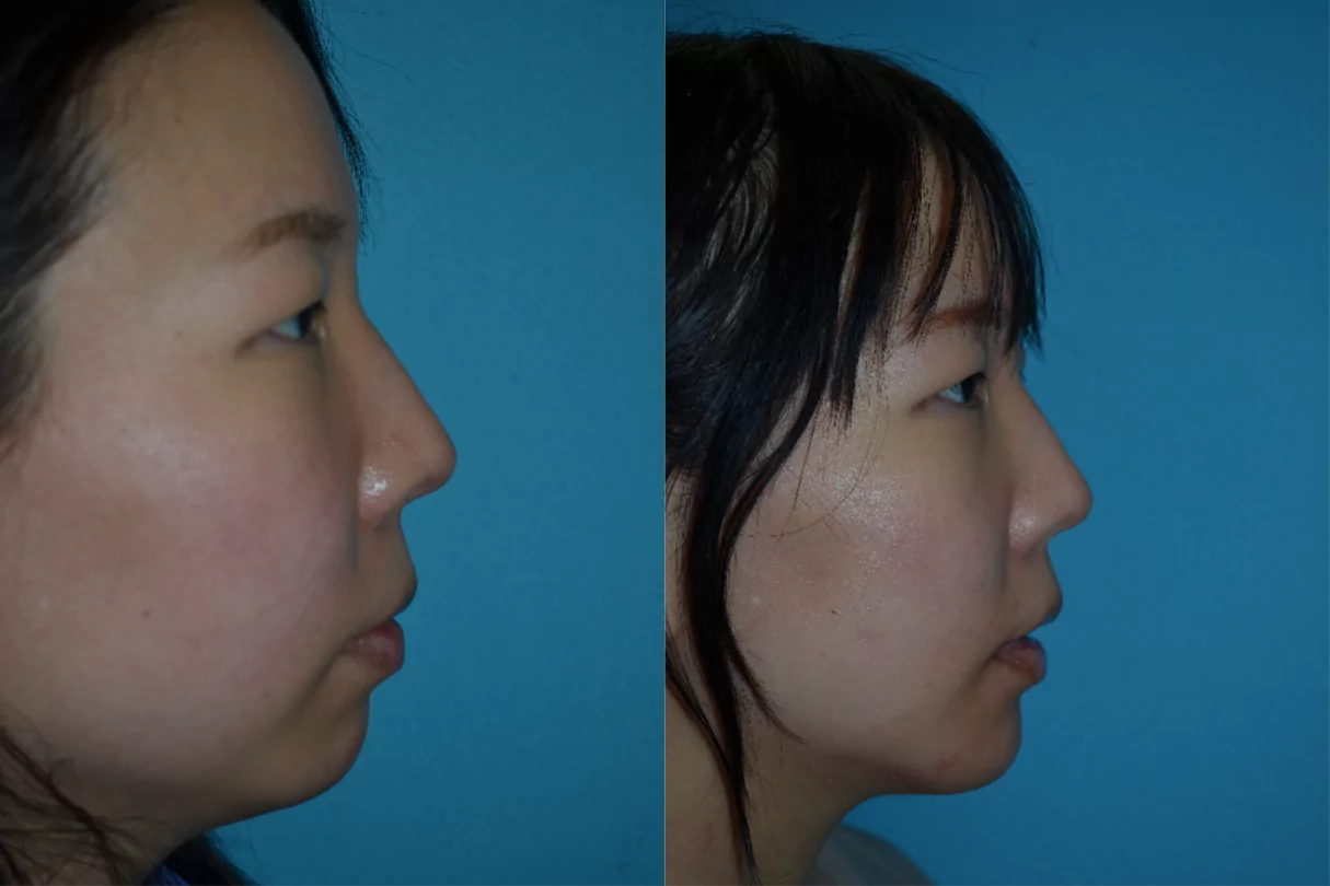 genioplasty before after